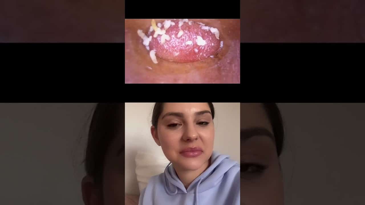 Esthetician Reacts to Whitehead Extractor