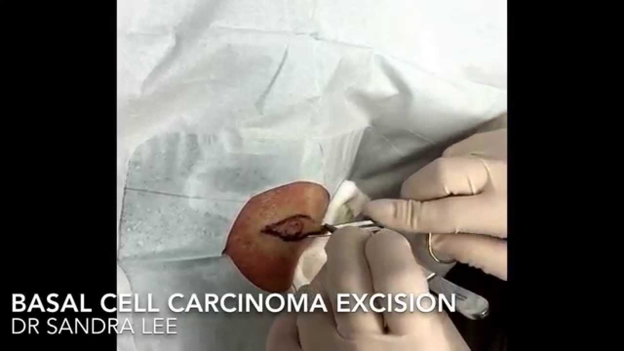 Excision of a basal cell carcinoma on the knee. For medical education- NSFE.