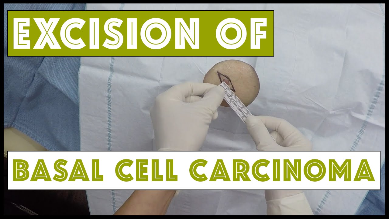Excision of a basal cell carcinoma on the thigh, wearing my GoPro!