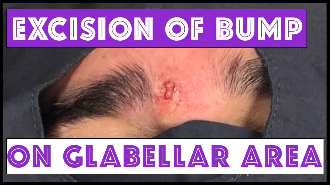 Excision of a bump on the glabella: Dr Pimple Popper