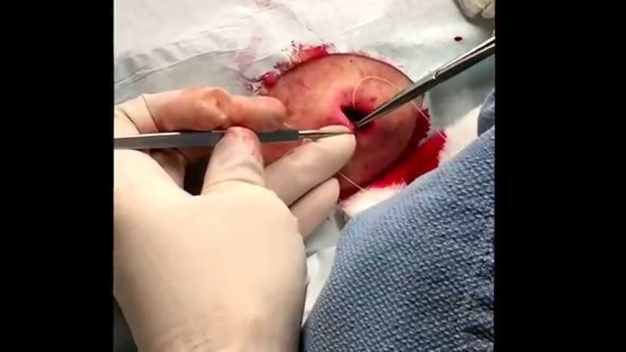 Excision of a cyst on the back. Part I of II. For medical education- NSFE.