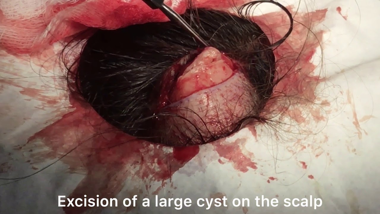 Excision of a large cyst on the scalp