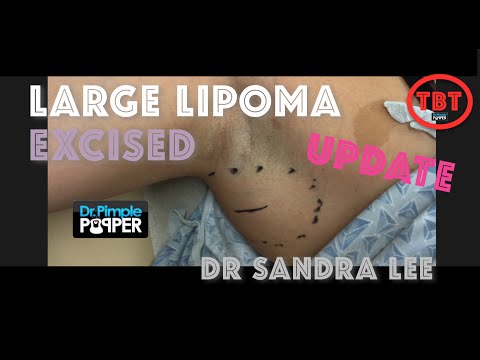 Excision of a lipoma on the axilla/armpit: Update with before and after pics