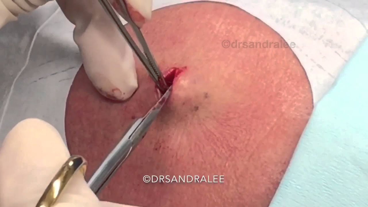 Excision of a lipoma on the forehead. For medical education- NSFE.
