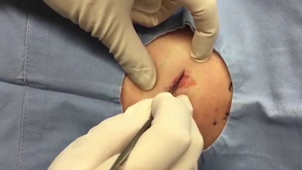Excision of a lipoma, right axilla. For medical education- NSFE.