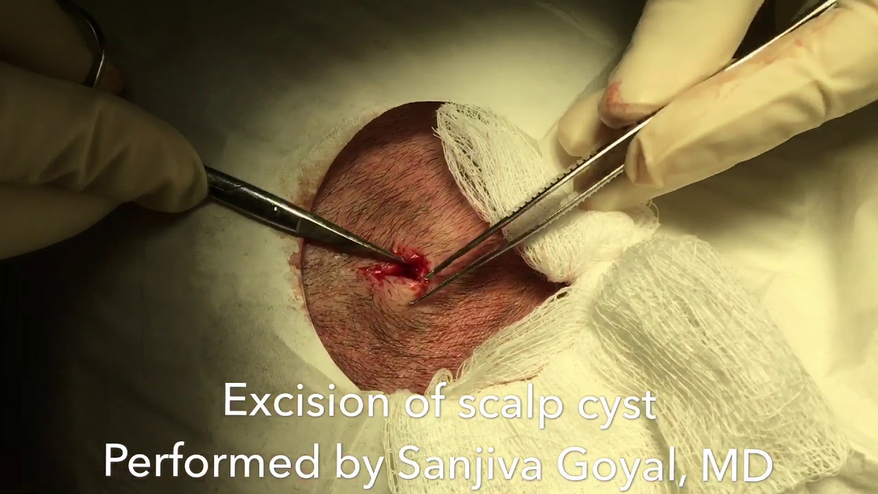 Excision of a scalp cyst