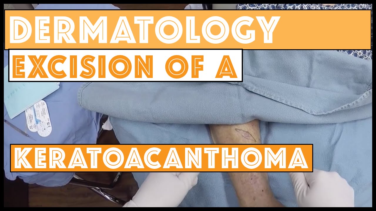 Excision of a skin cancer, a keratoacanthoma, filmed with my GoPro