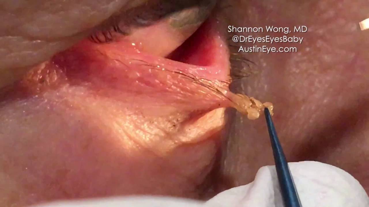 Excision of eyelid papilloma. 9-12-16.  Shannon Wong, MD
