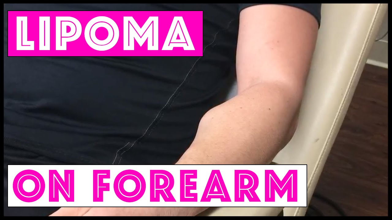 Excision of large lipoma on forearm