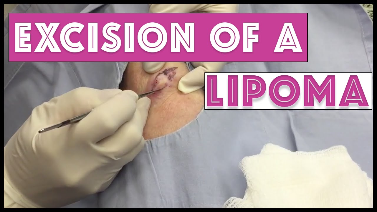Excision of recurrent lipoma on arm