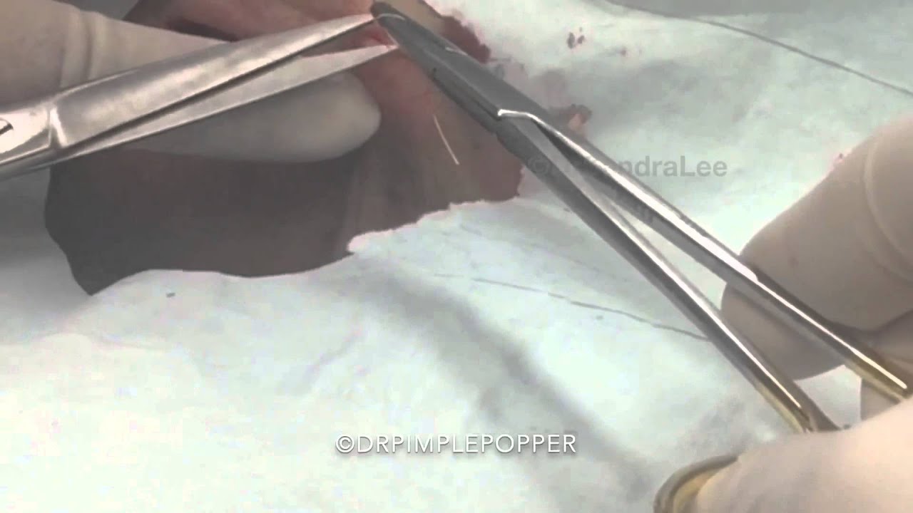 Excision of two cysts on the neck. For medical education- NSFE.