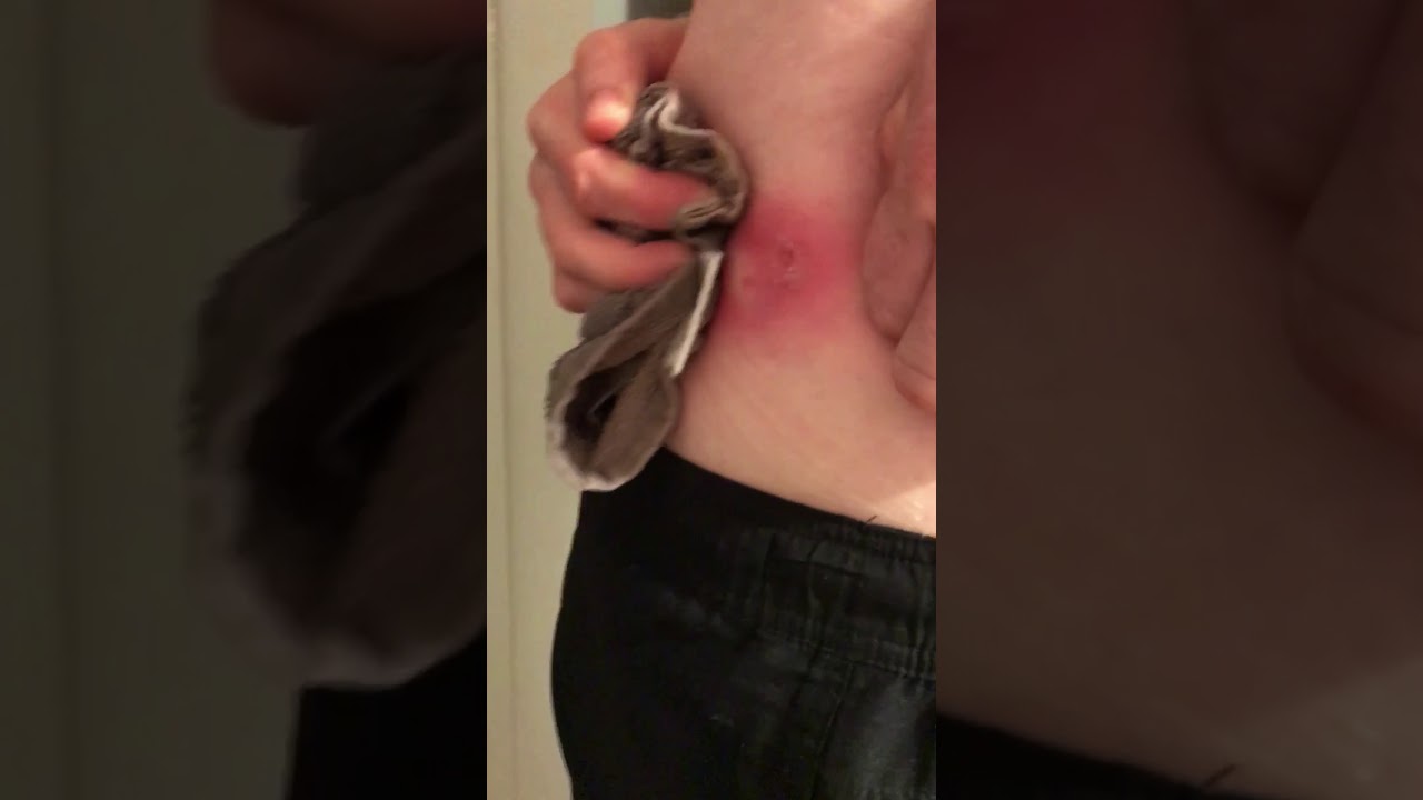 EXPLODING BACK CYST POP!