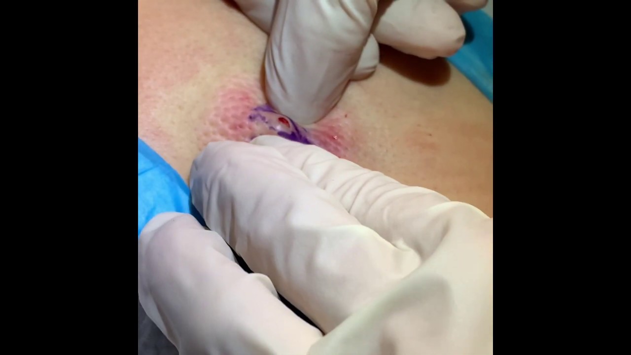 Exploding cyst part 1