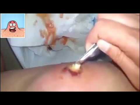 exploding cyst pus flowing
