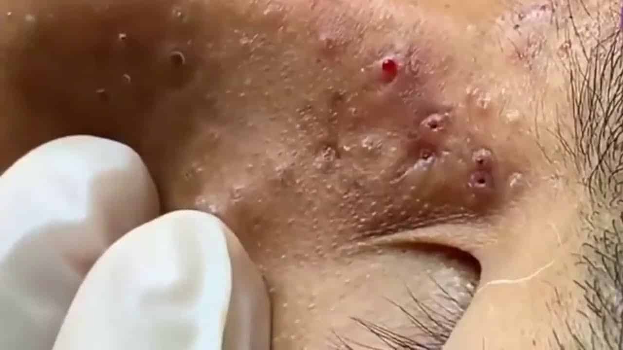 Explosive Cyst And Blackhead Pimple Popping #02