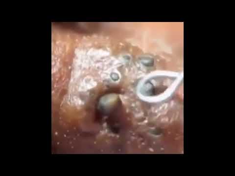 Explosive Cyst And Blackhead Pimple Popping   Pimple Popping Compilation