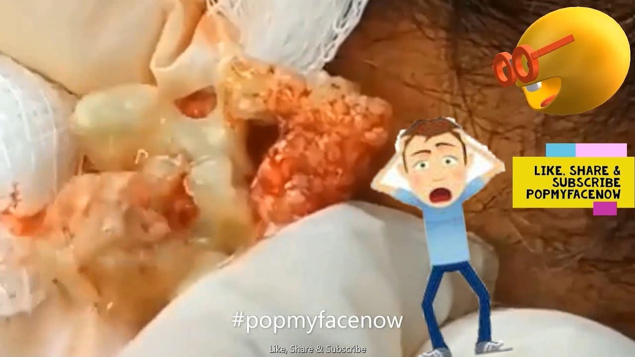 EXPLOSIVE CYSTS PIMPLE POPPING CYST SKIN PART# 15 / EXPLOSIVOS QUISTES SEBACEOS ??