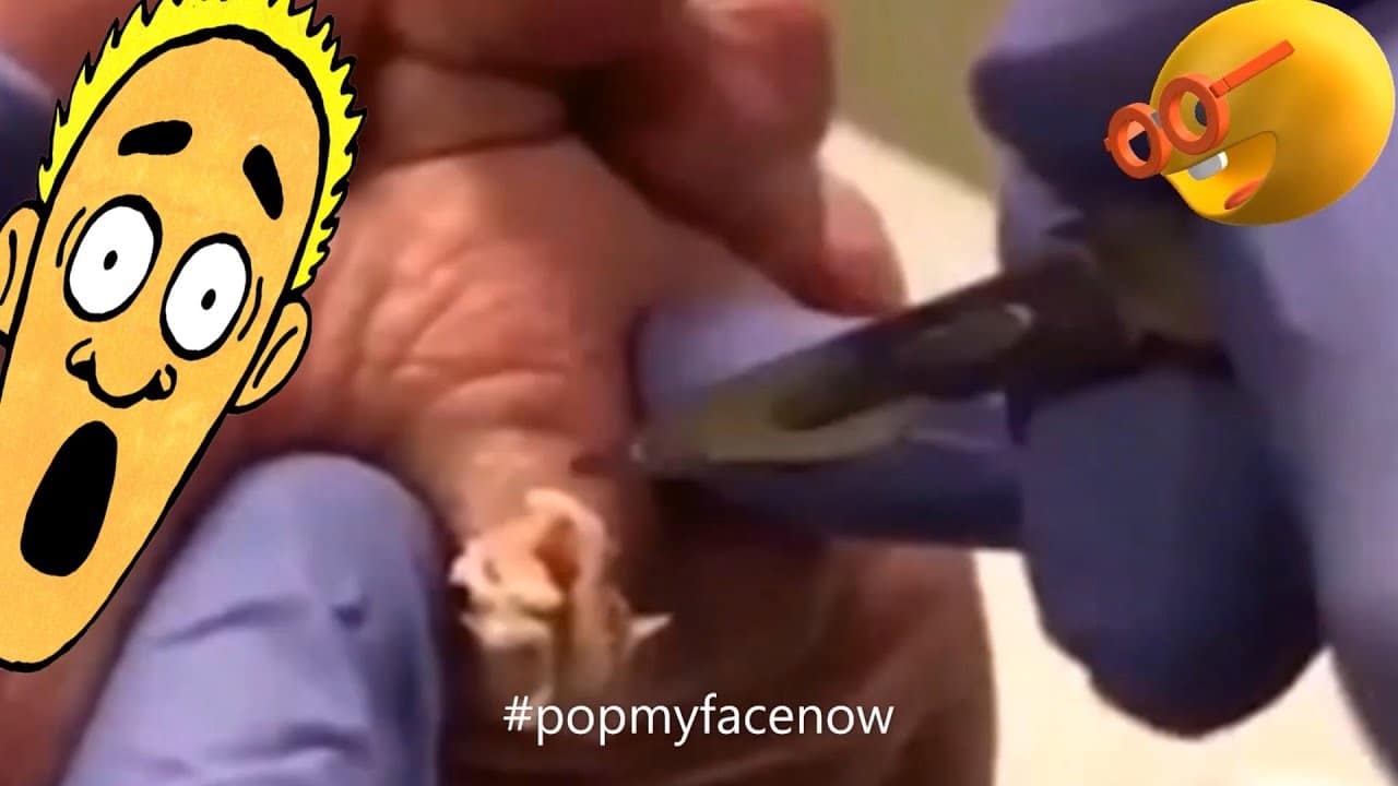 EXPLOSIVE CYSTS PIMPLE POPPING CYST SKIN PART# 14/ EXPLOSIVOS QUISTES SEBACEOS ??