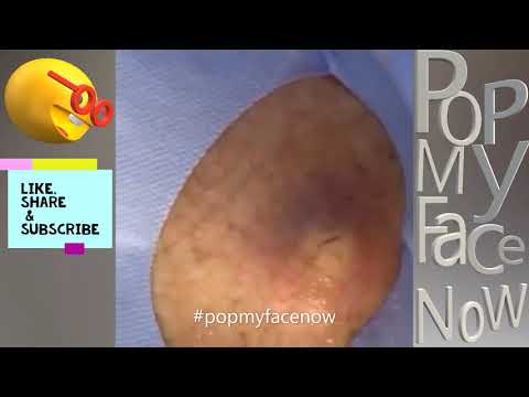 EXPLOSIVE CYSTS PIMPLE POPPING CYST SKIN PART# 7/ EXPLOSIVOS QUISTES SEBACEOS ??