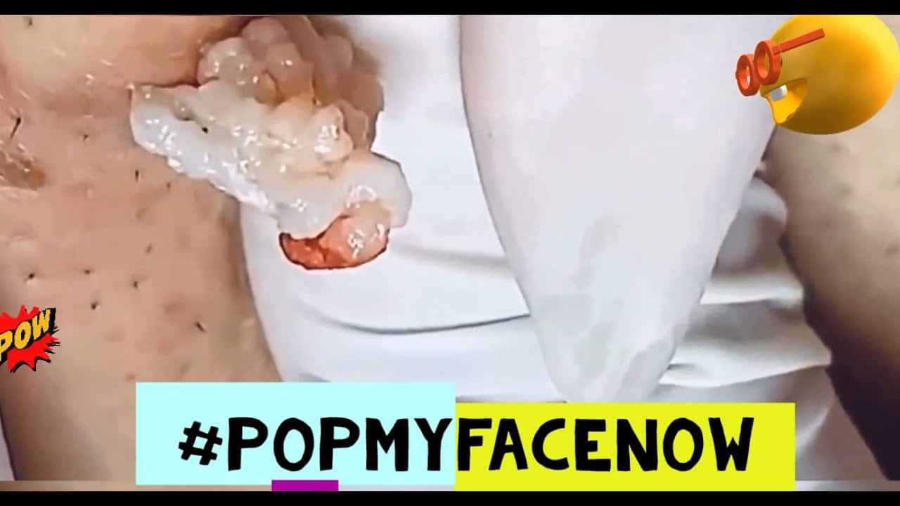 EXPLOSIVE CYSTS PIMPLE POPPING CYST SKIN PART#4 / EXPLOSIVOS QUISTES SEBACEOS ??