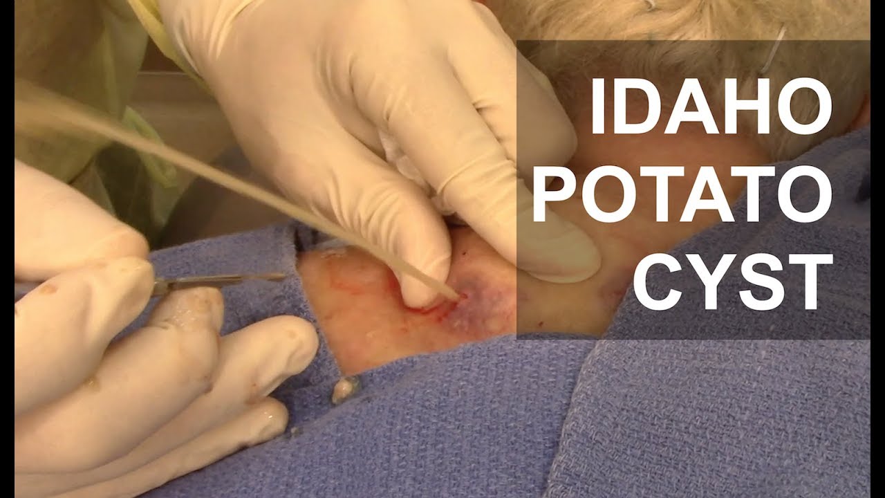 EXPLOSIVE Idaho Potato Gun Cyst!! | Dr. Derm