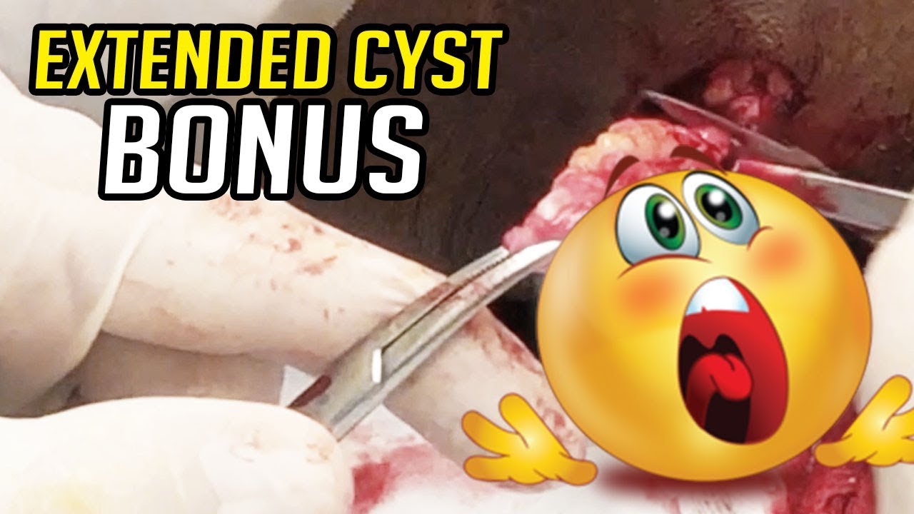 Extended Cyst Removal – Springtimes Bonus Video