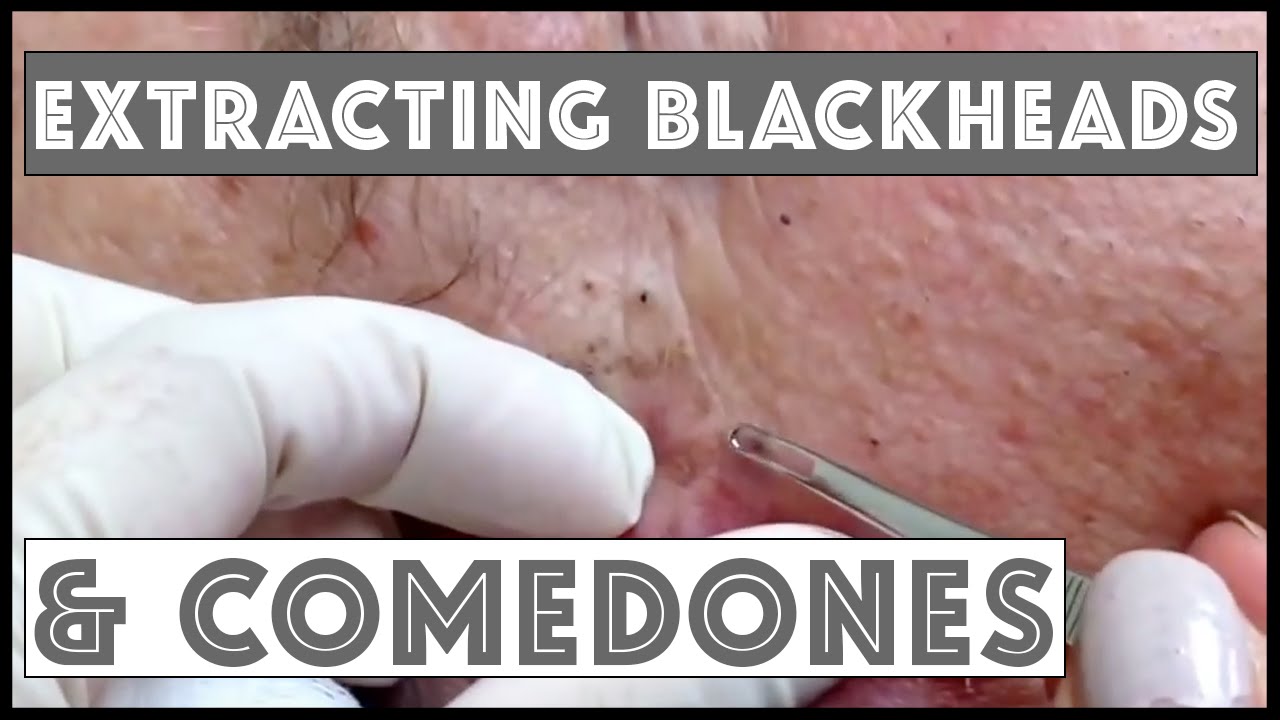 Extracting blackheads/comedones in condition called Favre-Racouchot For medical education- NSFE.
