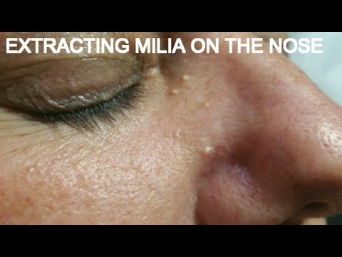 EXTRACTING MILIA ON THE NOSE