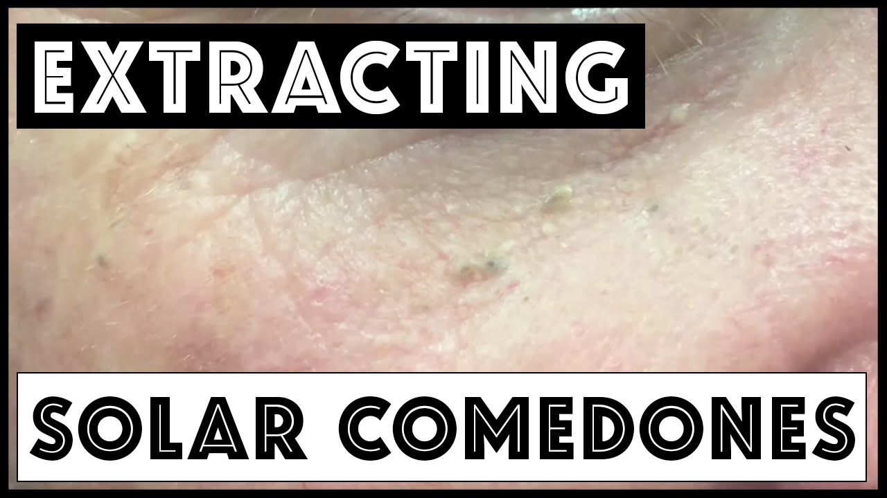 Extracting solar comedones and blackheads in forehead creases. For medical education- NSFE.