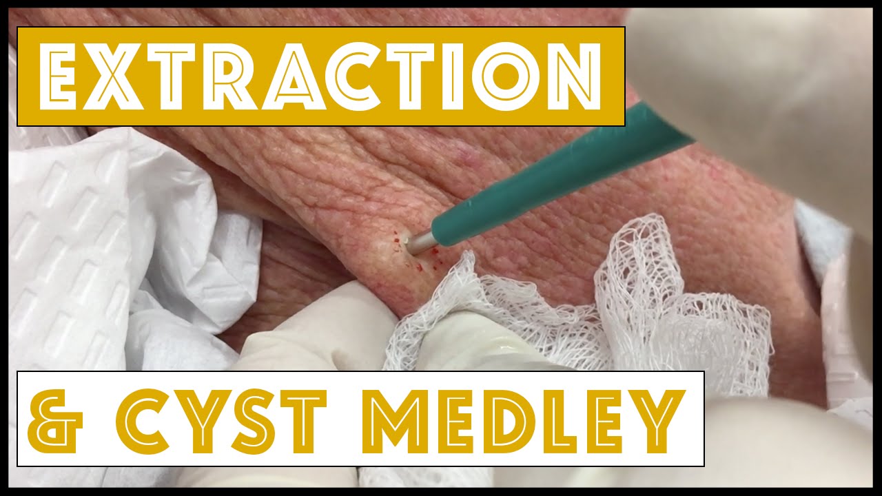Extraction & 2 cyst medley