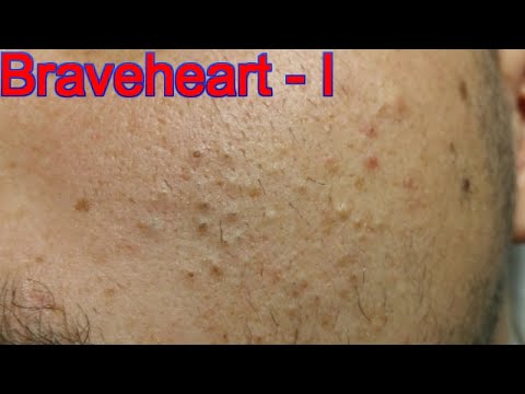 Extraction for Teenage Acne – Part 1 of 3