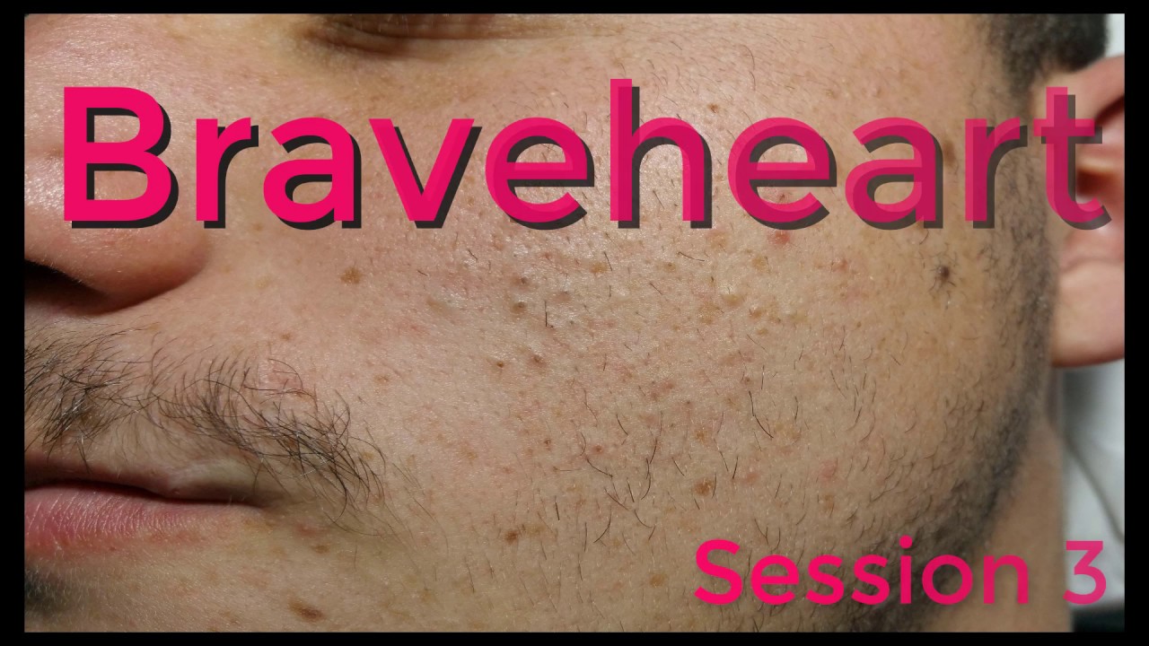 Extraction for Teenage Acne: Session 3- Part I