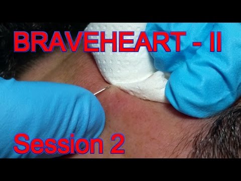 Extraction for Teenage Acne – Session II – Part 2 of 2