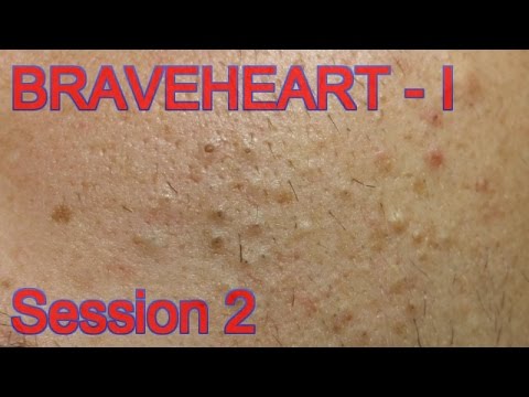 Extraction for Teenage Acne – Session II – Part 1 of 2
