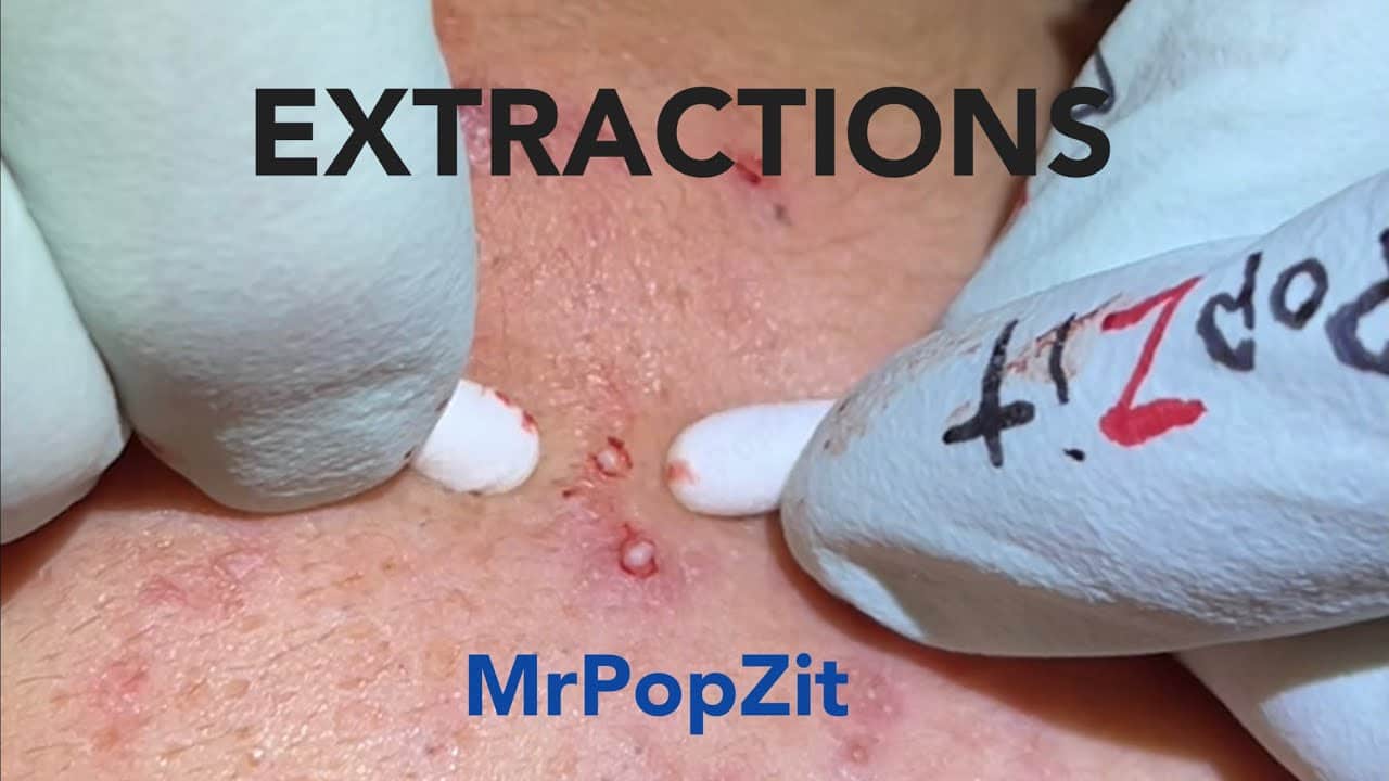 Extractions! Blackheads for days #4. Whiteheads, milia, acne cysts popped. 75% improved.