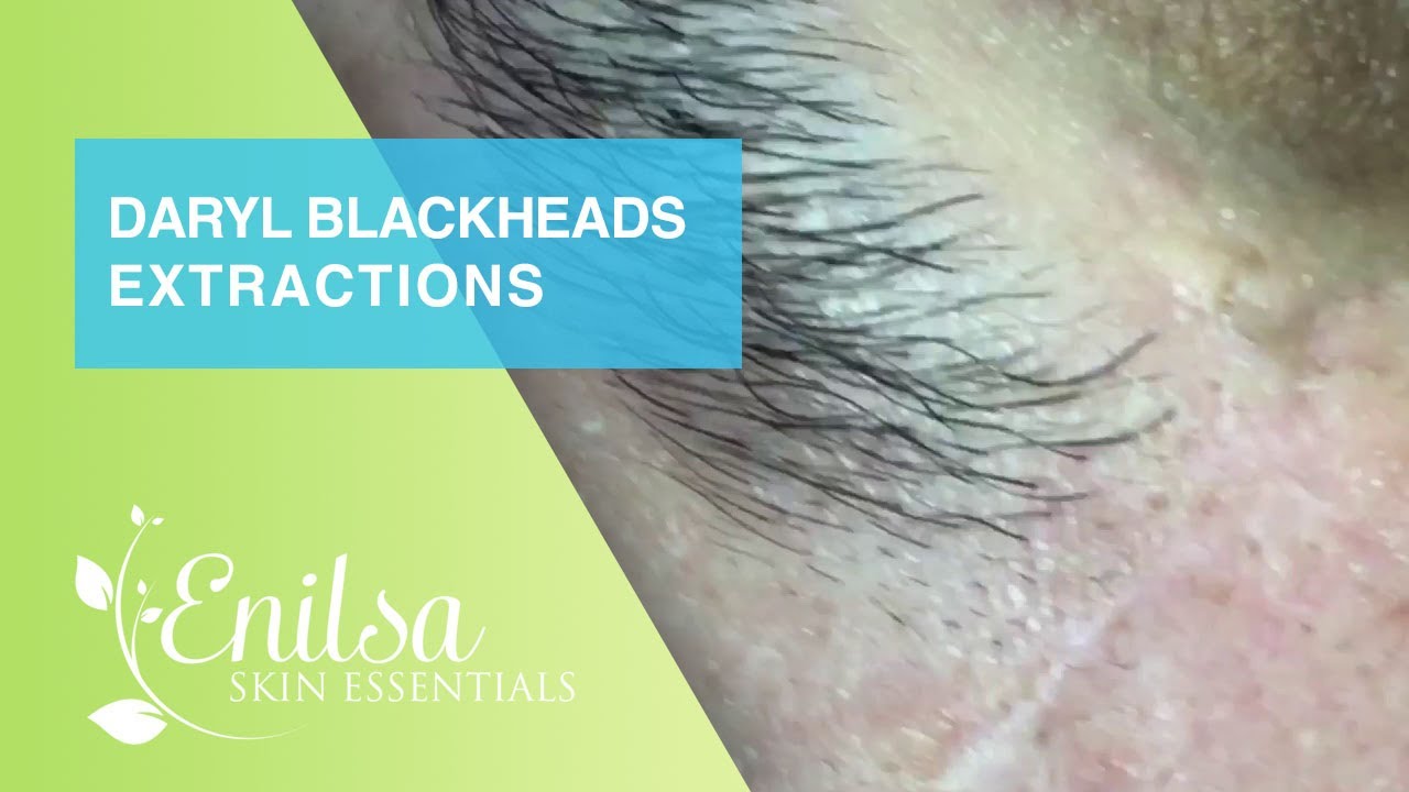 Extractions of Blackheads and Cyst on Daryl