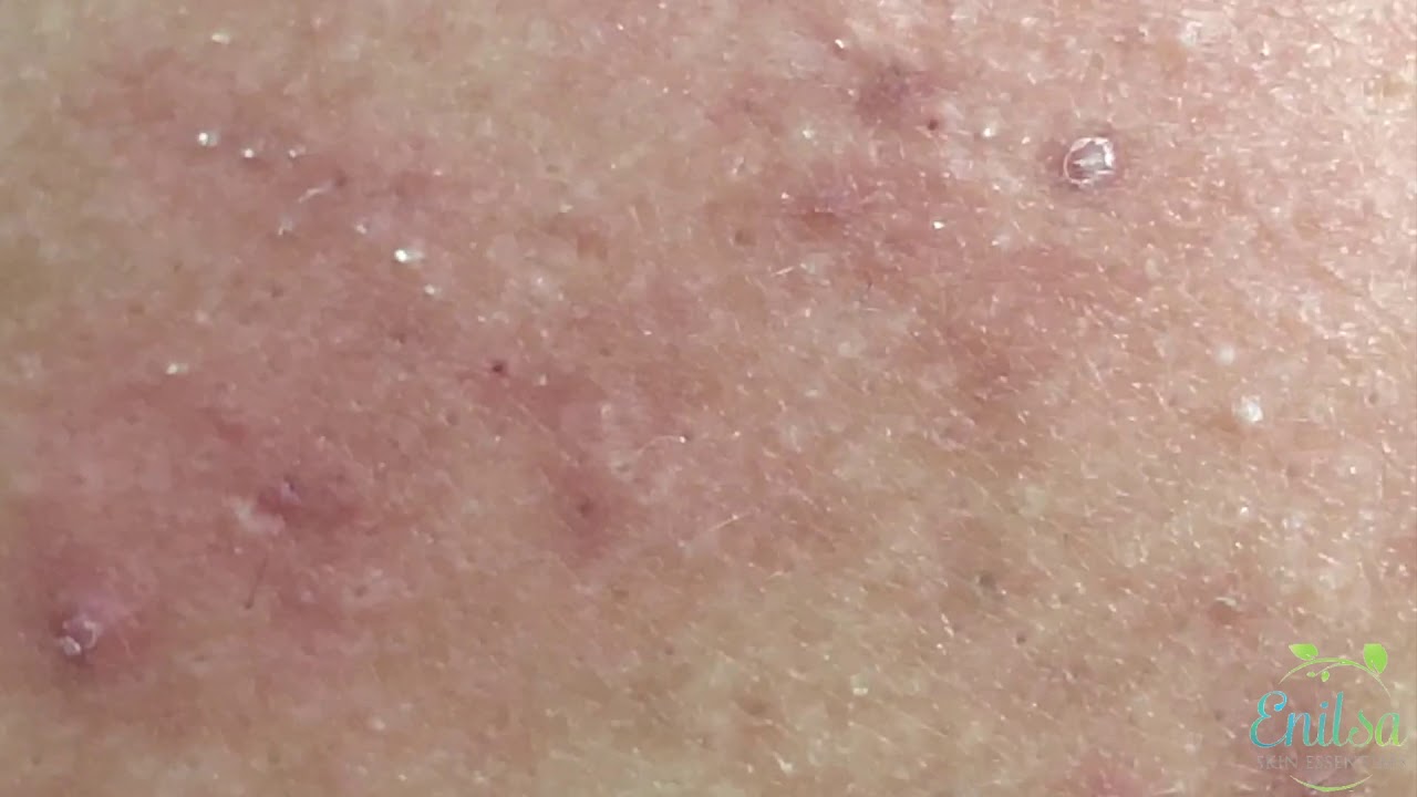 Extractions Of Blackheads Treatment On The Back / Christian
