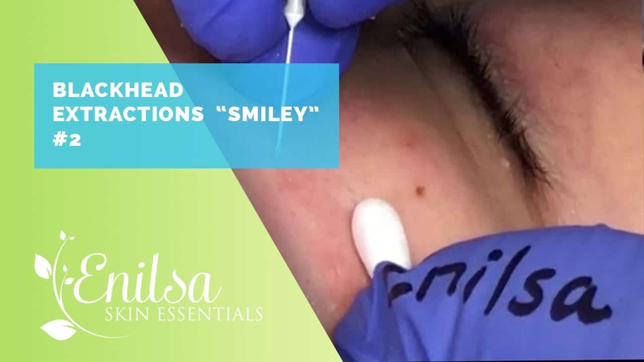 Extractions on “Smiley” treating Maturation Arrest Acne
