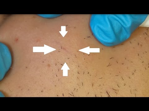 Extractions on Very Delicate Skin. Original sound background