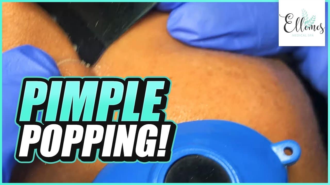 Extractions | Pimple Popping Experience Facial | Atlanta Medical Spa