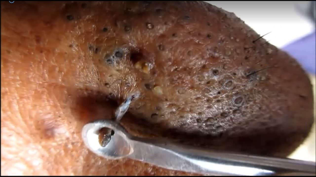 extreme blackhead popping on nose