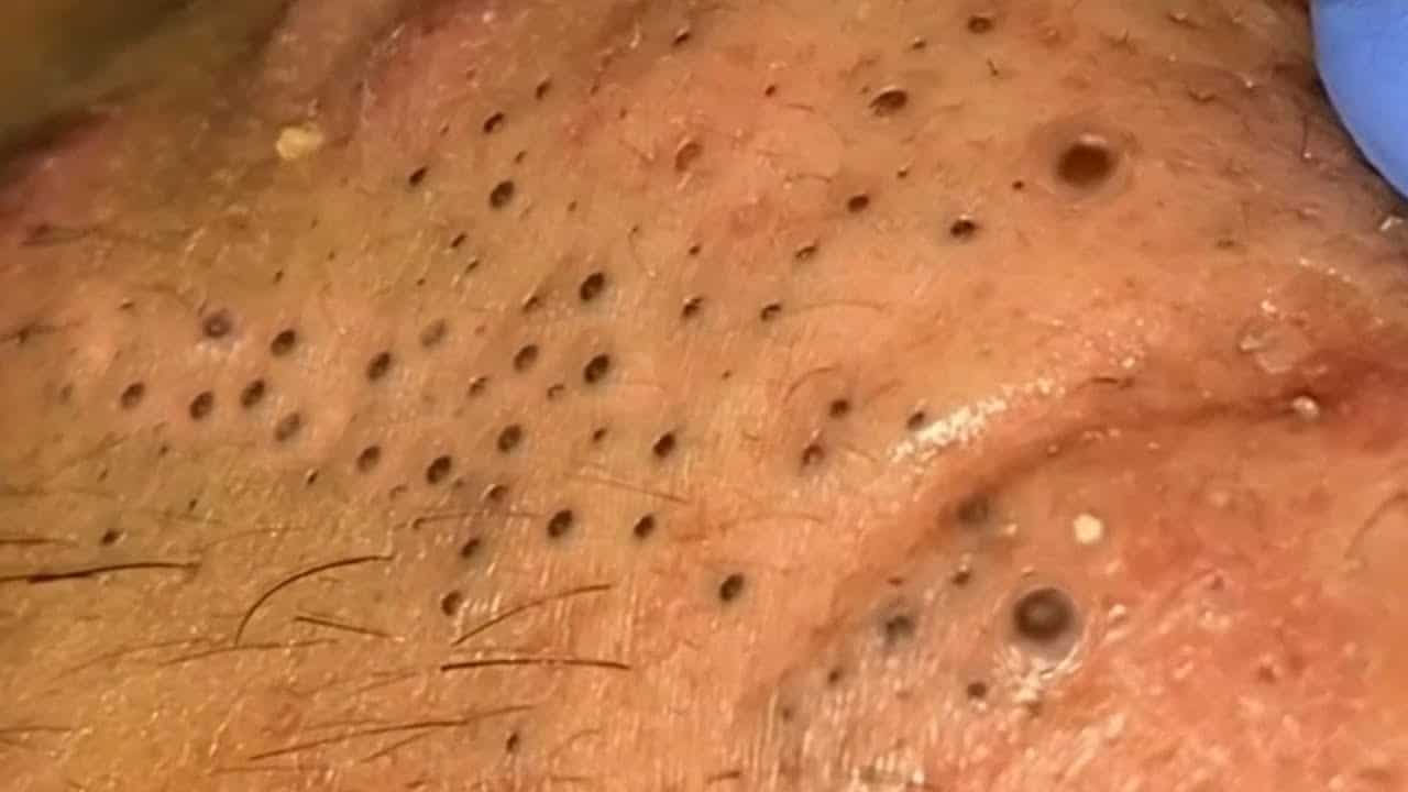Extreme Cysts, Top 3 Cysts, Top 10 Biggest Blackheads – Top Searches