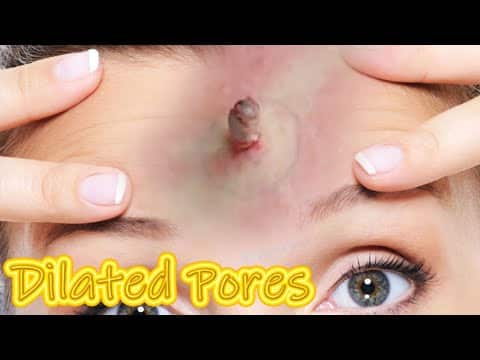 Extreme Dilated Pores of Winer!  12 Pimple Pops and Cysts!
