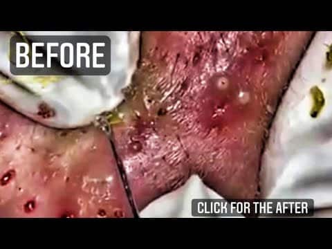 Extreme Pimple Popping, Acne, Cysts and Pustules!  Do you LOVE popping?