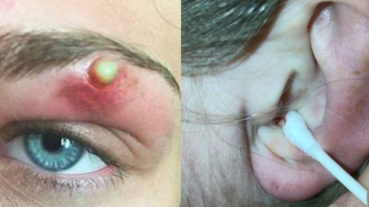 Eye Cysts, Chin Zits, Ear Blackheads and More Comedones