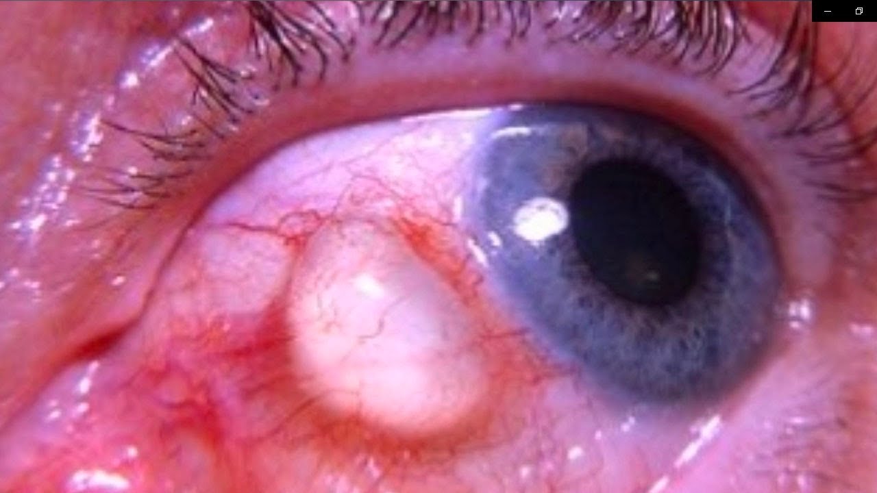 Eye Cysts – What Are Conjunctival Inclusion Cysts