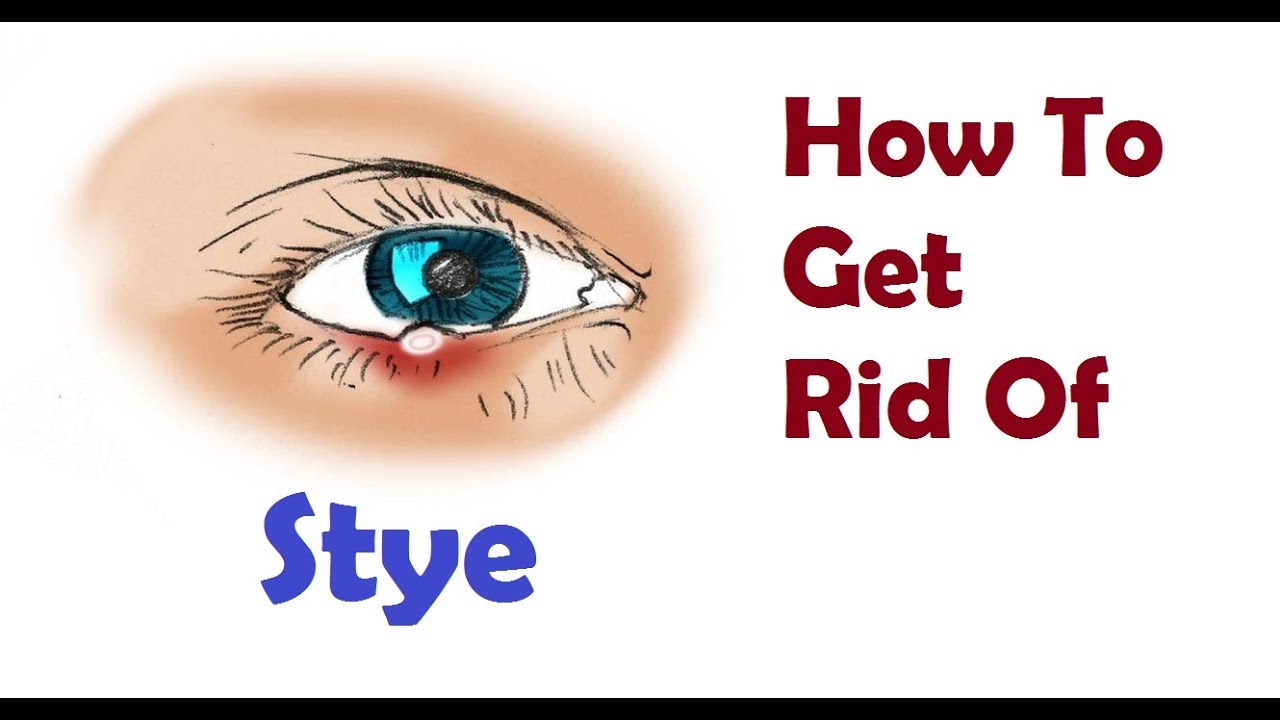 eye Disease stye and how to get rid of this? (Hindi)