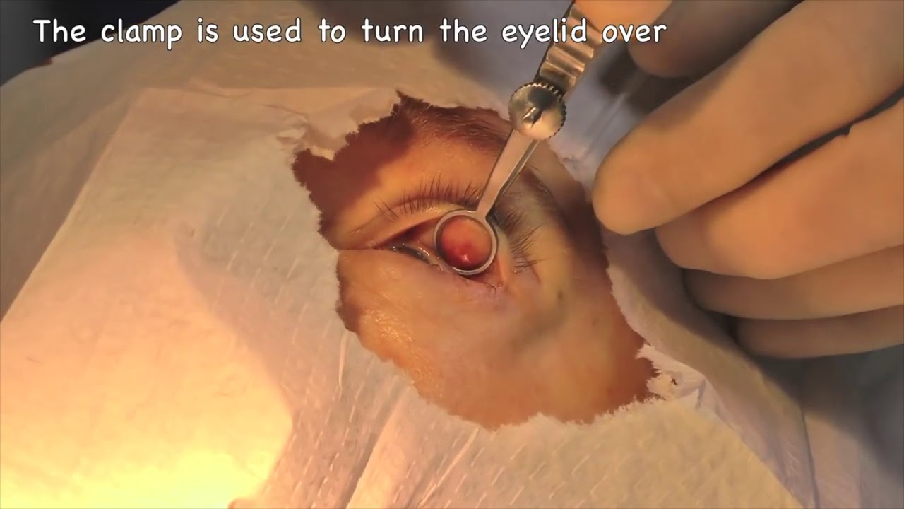 Eyelid cyst