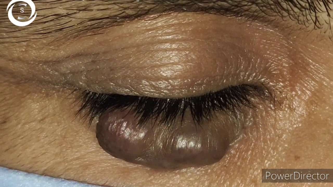 Eyelid varices