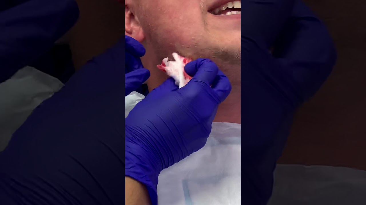 Face cyst extracted